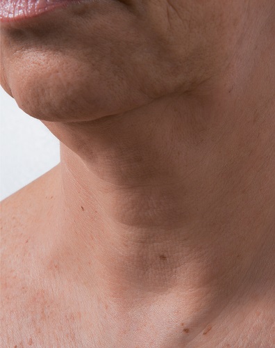 Viscoderm Neck - After